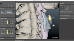 Längenmessung eines Lymphknoten