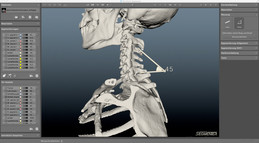 Winkelmessung von Wirbelkörpern