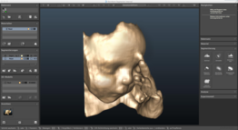 3D Visualization of an Ultrasound Dataset